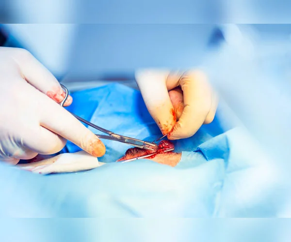 LAPAROSCOPIC OVARY REMOVAL