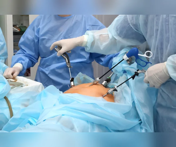 LAPAROSCOPIC MYOMECTOMY