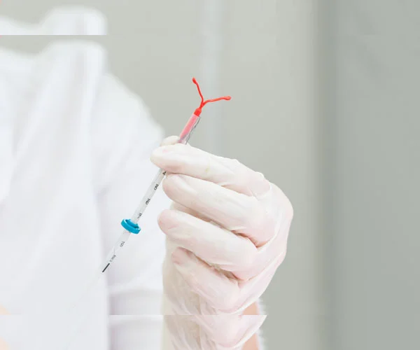 TUBAL LIGATION
